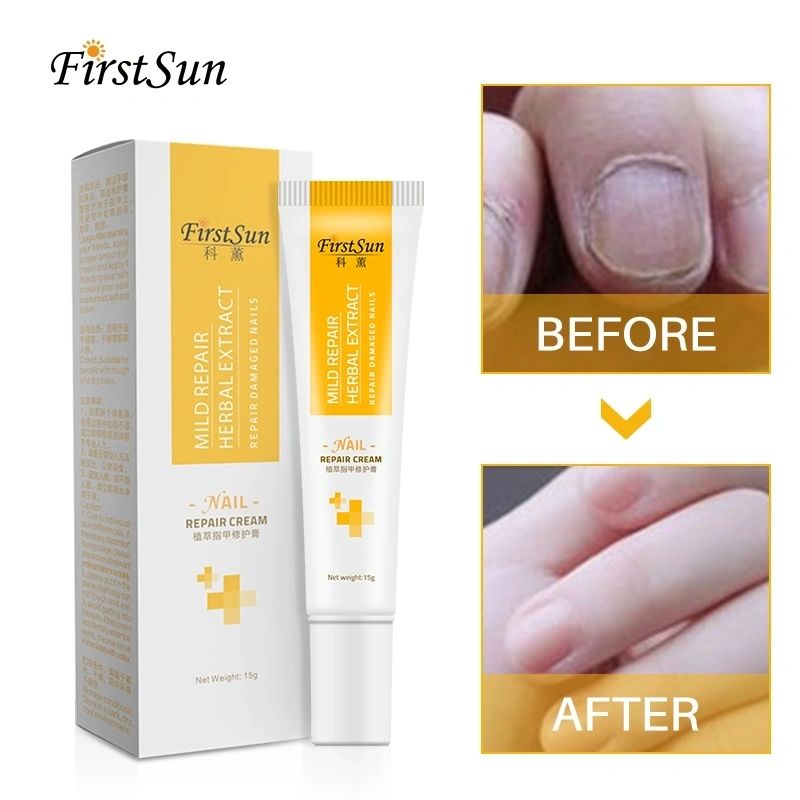 10ml Fungus Nail Repair Serum Treatment